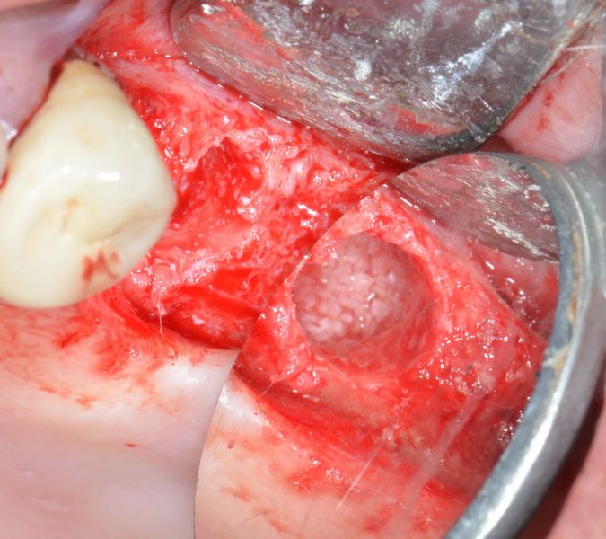 Prior to implant placement, BioOss particles are removed from the canal.