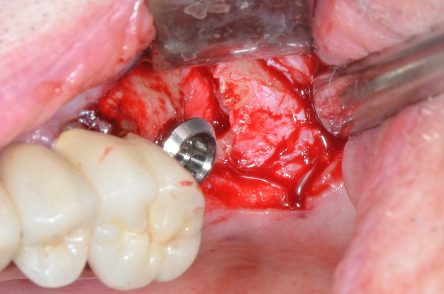 Das Implantat kann mesial des grossen Kammdefektes eingebracht werden.