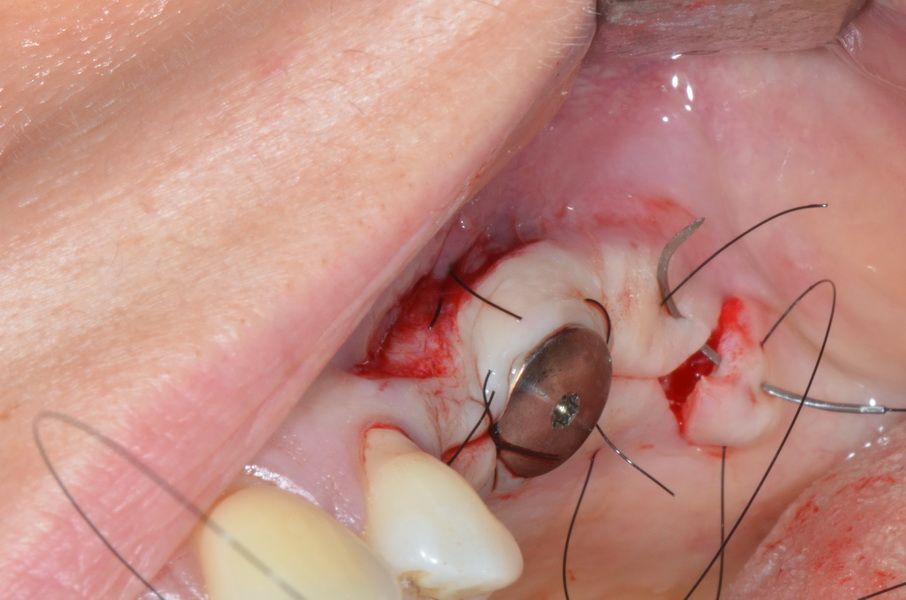 Closure of the distal reliefs with a mattress suture