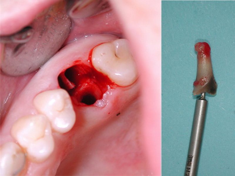 Even with the most ideal hard and soft tissue conditions (St.n. Benex extraction), a mucoperiosteal flap opening is advantageously made.