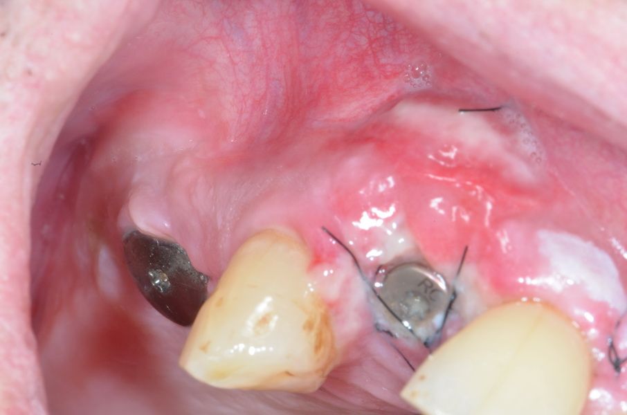 zusätzliche Implantation regio 12