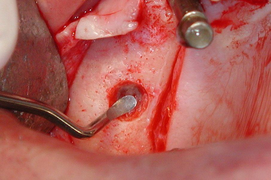 Circular release of the Schneiderian membrane with a fine instrument