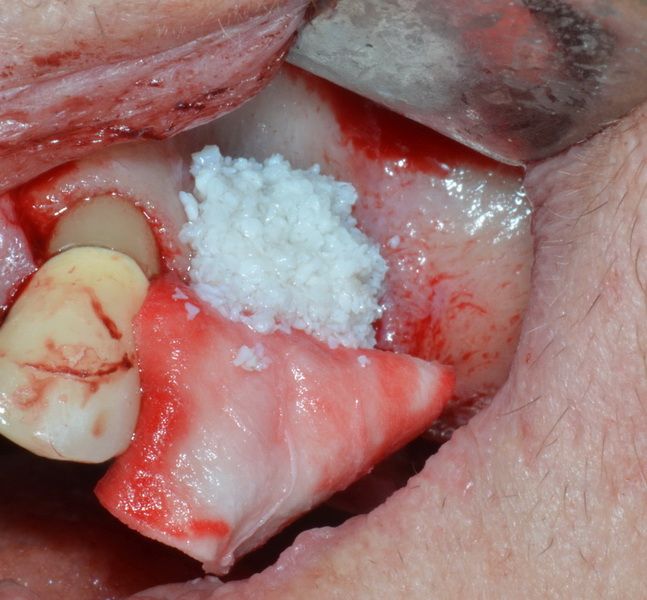Implantation with sinus lift regio 26 and buccal augmentation regio 24