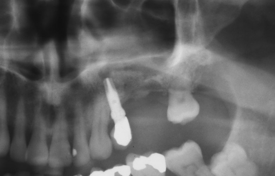 Fall 5: St.nach Implantatverlust nach zweizeitigem Sinuslift/Implantation, Fenstertechnik alio loco. 