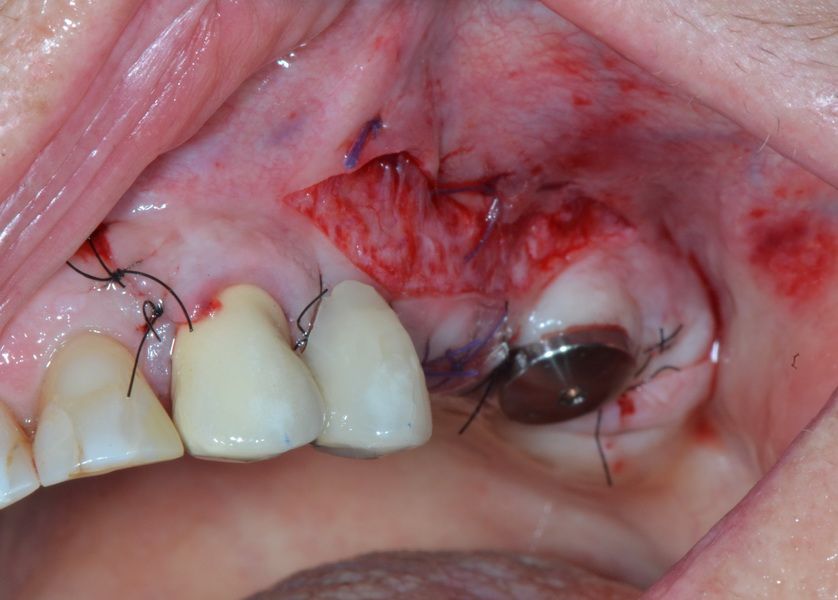 situ immediately postoperatively