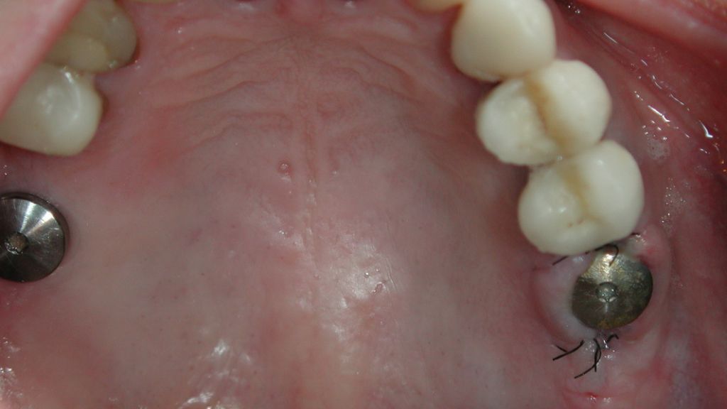 Case 3: Free end gap treatment on both sides, 6-occlusion