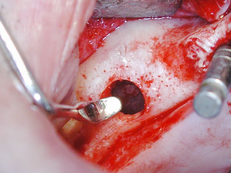 After extended profile drilling the membrane elevation is even easier.