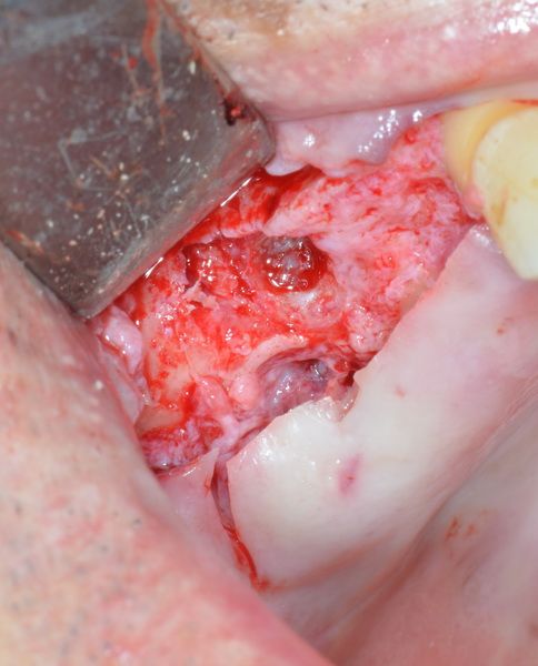 bukko-distal Kammdefekt bis zur Sinuskortikalis.
Situ nach Implantatbettaufbereitung, gut sichtbar die Meissnersche Membran.