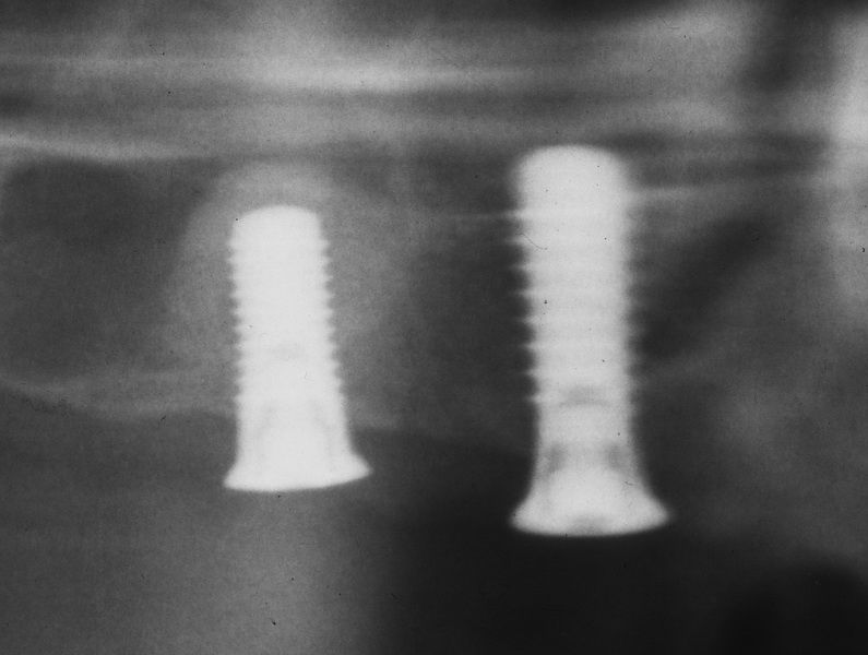 Despite the rupture could be far augmented: Rx postoperatively.