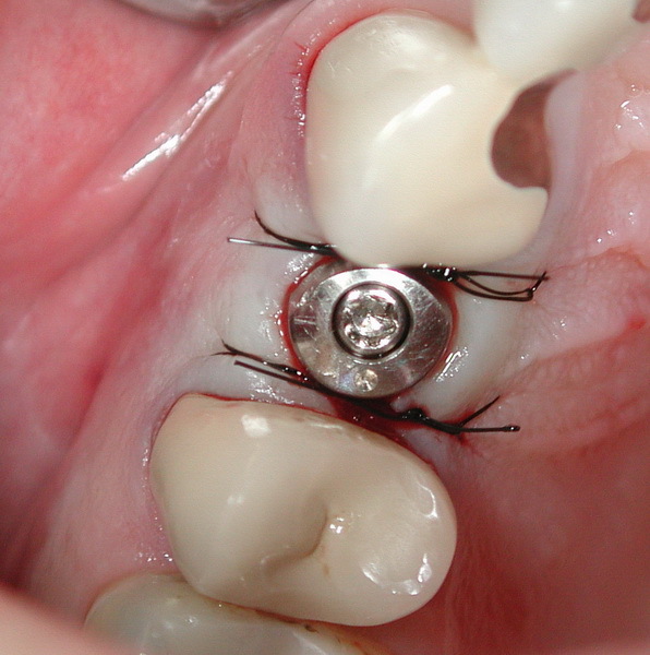 Transmucosal healing, suture technique
