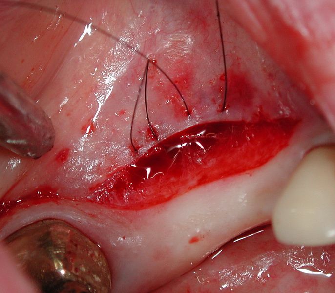 The wide mattress suture for the fixation of the mucosal flap on the periosteum.