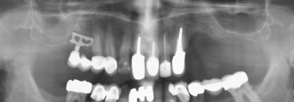 Case 3: status after removal of the subperiostal disk implant