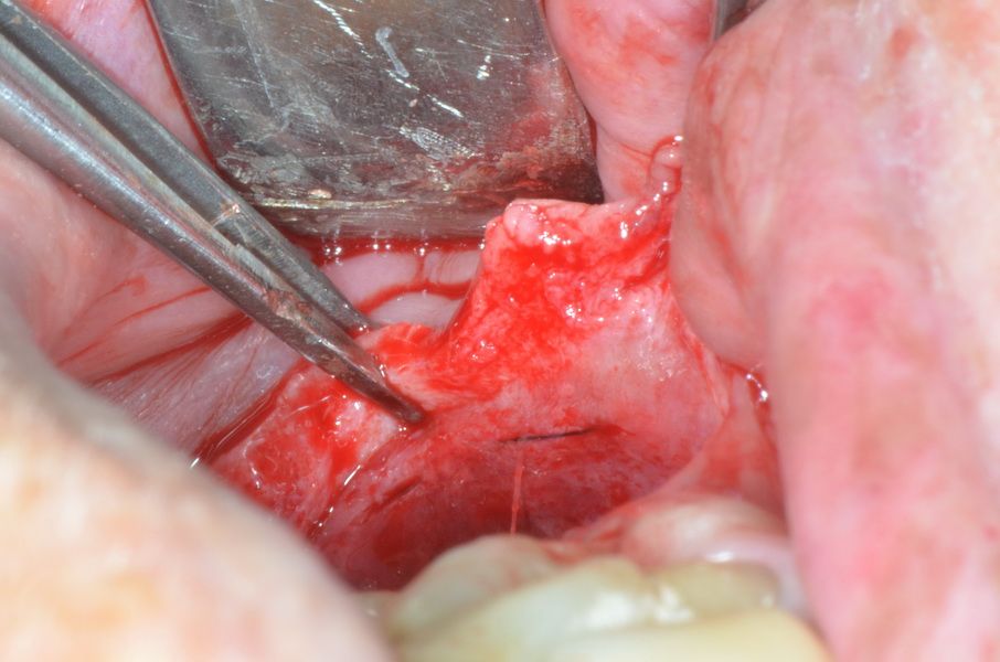 After the opening of the mucoperiosteal flap, the vestibular mattress suture of periostal can be recognized.