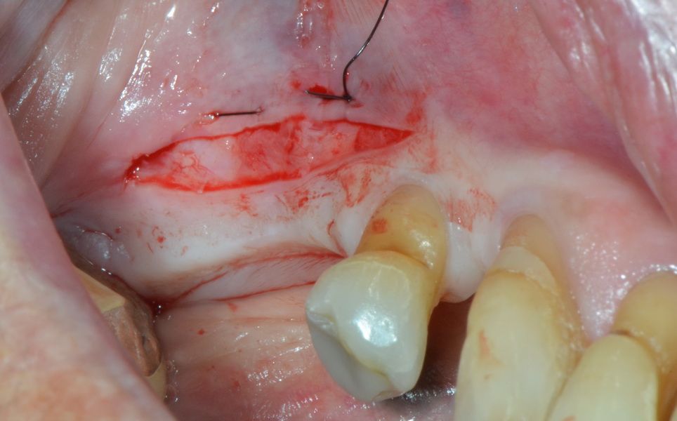 Only after the vestibulum suture is the incision made for the opening of the mucoperiosteal flap.