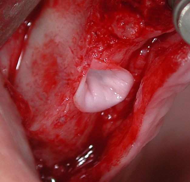A wetted collagen membrane is inserted funnel-shaped.