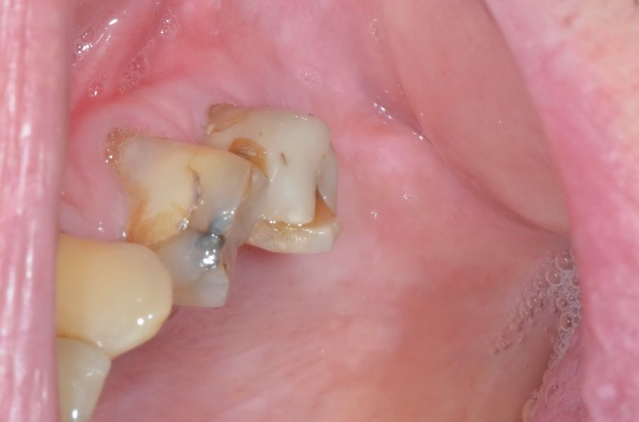 clinical status prior the sinuslift/implantation