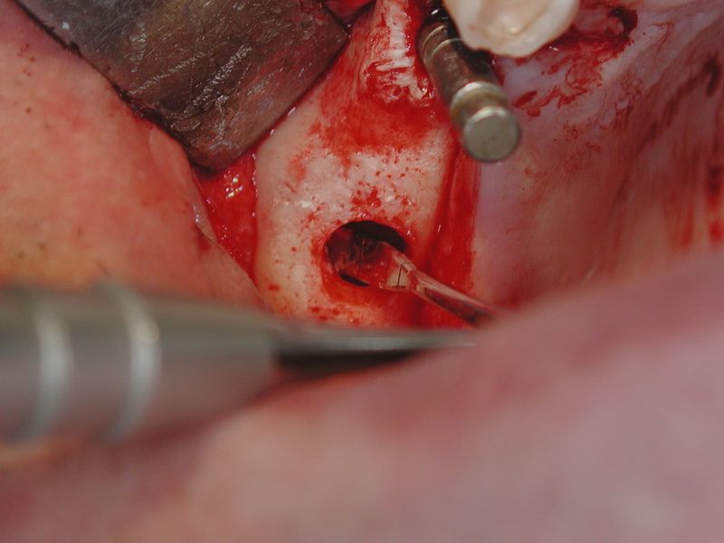 The elevation of the membrane should be from crest height ca implant length minus two millimeters.
The elevator has a 2-mm graduation.