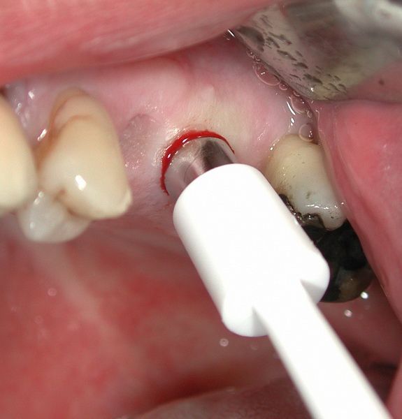 Access via mucosal punching is possible